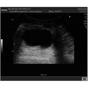 کاهش نویز Speckle در تصاویر سونوگرافی در MATLAB