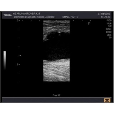 کاهش نویز Speckle در تصاویر سونوگرافی در MATLAB