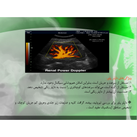 پاورپوینت آماده اثر سونوگرافی داپلر در تشخیص گرفتگی عروق